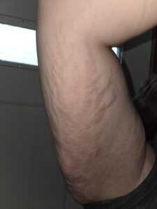 A white arm with light red stretch marks.